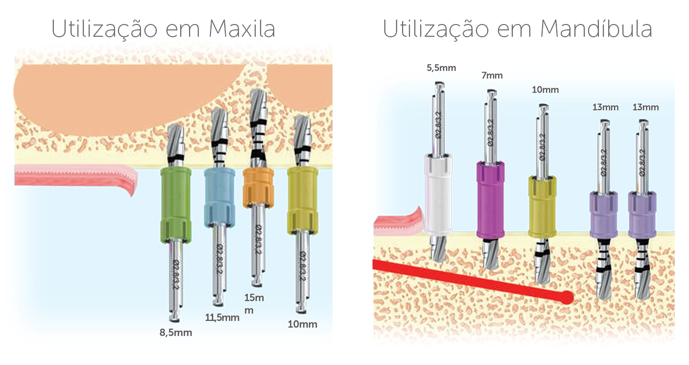 Kit Stop Drill®, detalhe